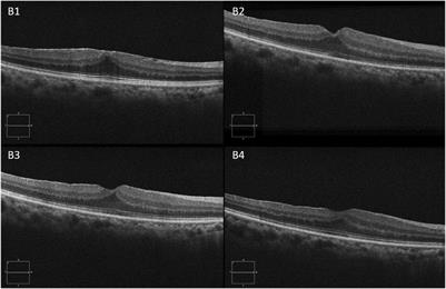 Intraoperative slow-release dexamethasone intravitreal implant (Ozurdex) in epiretinal membrane peeling surgery: a prospective randomized controlled trial